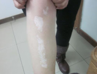 Vitiligo Causes, Treatment & Home Remedies