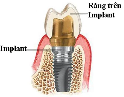 Các bộ phận cấu thành Implant nha khoa