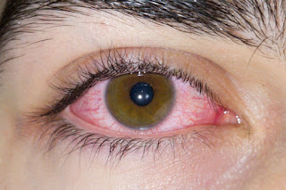 symptoms of eye flu