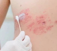 대상포진 증상, 원인, 치료방법, 전문병원 (칼로 찌르는 통증)