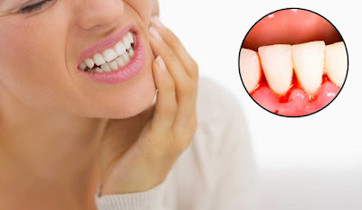 Viêm chân răng lâu ngày nguy hiểm như thế nào? 1