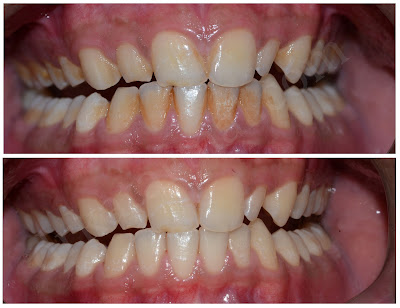 Teeth Cleaning - Removal of Tobacco Stain