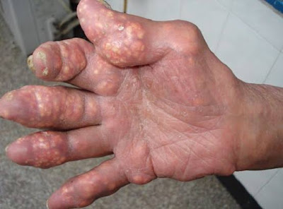 Nguyên nhân và triệu chứng của bệnh gout