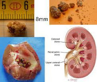 Obat Herbal Penyakit Batu Ginjal