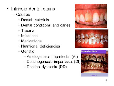 Tooth Stains