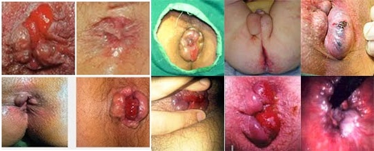Obat Bab Keras Untuk Orang Dewasa