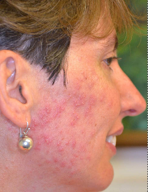 Acne of the lower part of face and neck