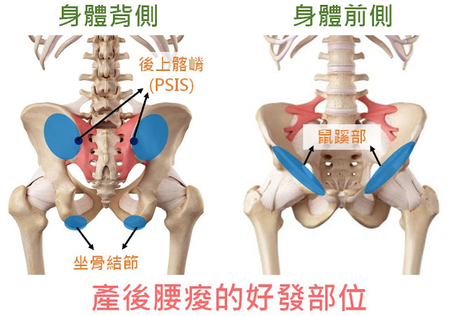 產後腰痠、PSIS、骨盆痠、鼠蹊部痠痛、腹股溝、腰痠