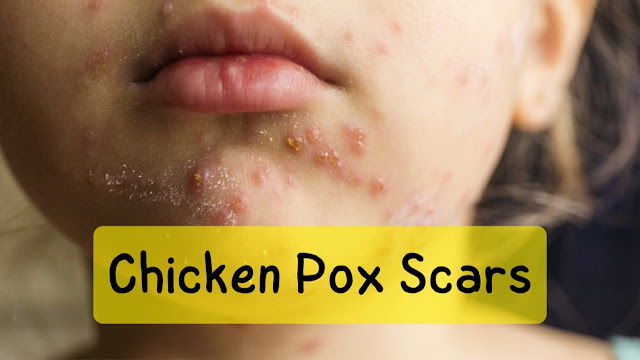 chicken pox scars treatment