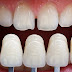 Thông tin bọc răng sứ nguyên hàm giá bao nhiêu