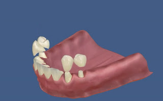имплантация зубов и протезирование зубов