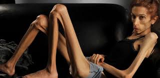 The Malign Effects Of Anorexia Nervosa