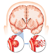  Beberapa hal yang disinyalir menjadi tanda-tanda stroke bisa dengan relatif gampang dikenali Gejala Stroke