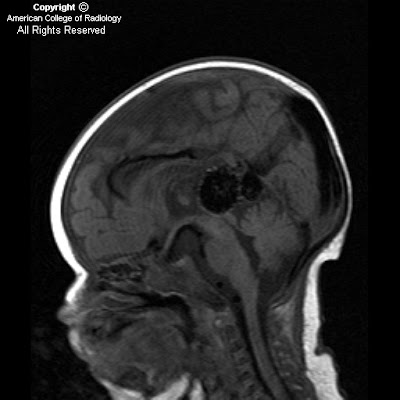 artery injection (lateral