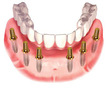 Cấy ghép implant theo phương pháp mới nhất 2016