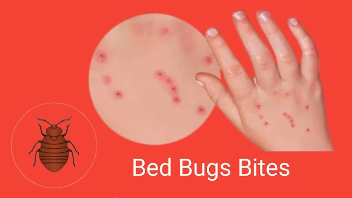 bed bugs,bed bugs bites,bed bug prevention,bed bugs bite treatment,bed bugs look like,bed bug symptoms