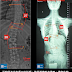 脊椎側彎矯正案例14 - 治療5天/腰椎側彎 43.5度降到26度