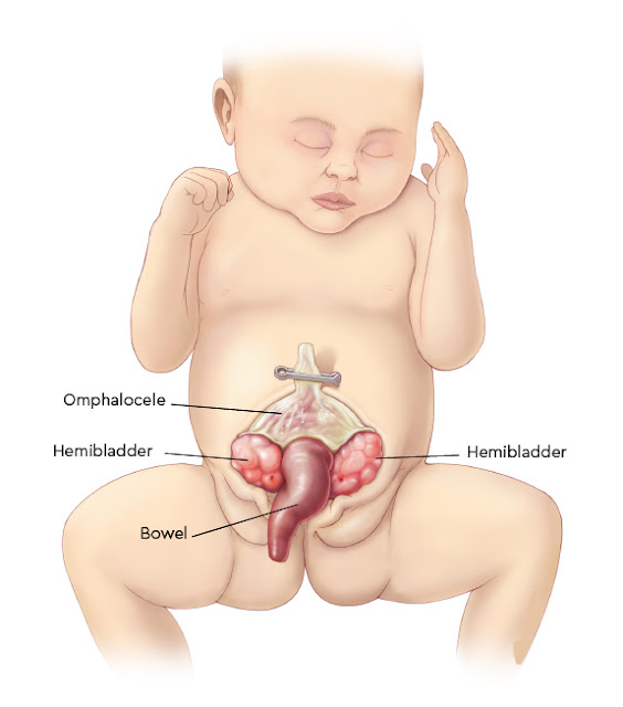 Cloacal exstrophy