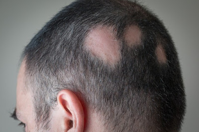 alopecia areata