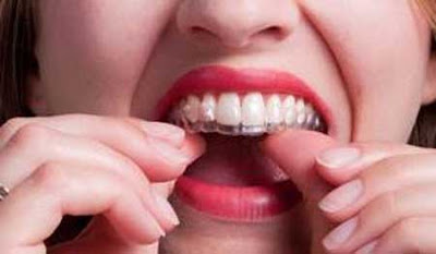 Phân tích niềng răng trong suốt có tốt không từ nha sĩ-2