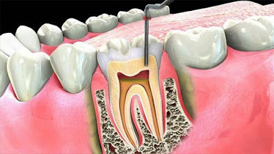 Lấy tủy bọc răng sứ áp dụng khi nào? 1