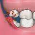 Răng khôn mọc lệch khắc phục thế nào an toàn?
