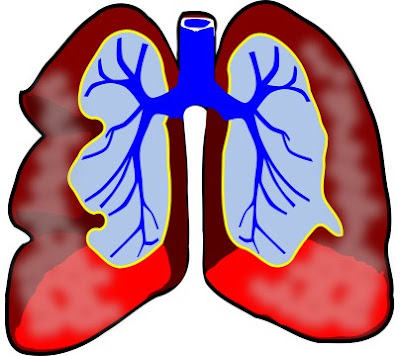 Lung cancer, lung cancer early symptoms, what causes lung cancer, causes of lung cancer, etiology of lung cancer, smoking, smoking lungs, smoking causes lung cancer, asbestos causing lung cancer, “asbestos” + ”lung”, lung cancer cough