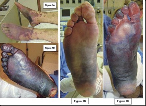 PURPURA FULMINANS.SEEN IN PROTEIN CS DEFICIENCY WHEN GIVEN WARF.