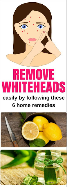 Remove Whiteheads Easily By Following These 6 Home Remedies!!!