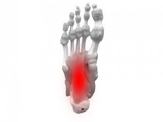 足底筋膜炎の患部である足底筋の写真