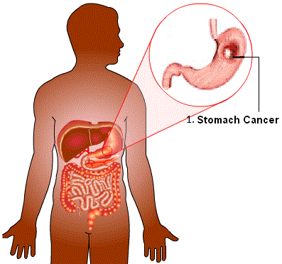 stomach-cancer-from-smoking