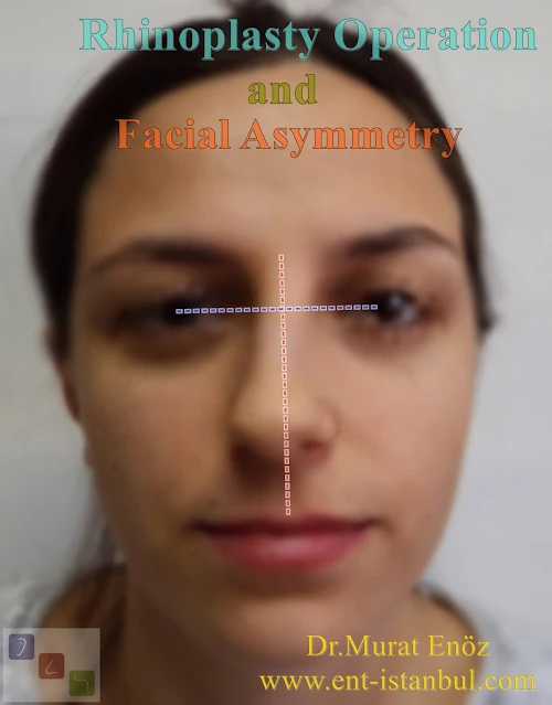 facial asymmetry, deviated nose, rhinoplasty, nose aesthetic, crooked nose, traumatic facial bone asymmetry