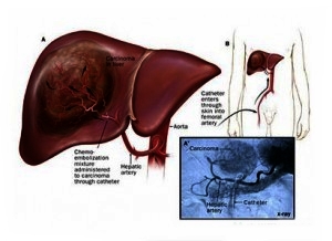 Pengobatan Terbaik Untuk Tumor Hati Tradisional