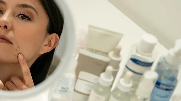 Why a Change in Lifestyle May Be the Best Acne Treatment
