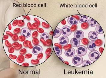 Penyakit Leukemia