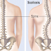 What is scoliosis , and what are the Treatements