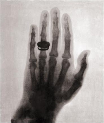 First X-ray (1896)