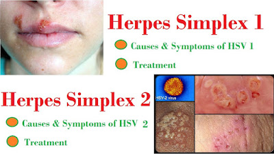 Penyembuhan Herpes Genital (Herpes Simplex) 