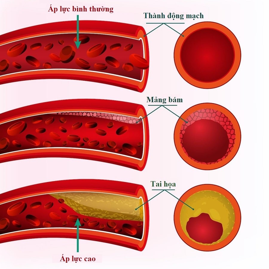 Mảng bám xấu và cholesterol xấu bám lên thành mạch, tích tụ dần làm hẹp đường máu lưu chuyển gây bệnh huyết áp