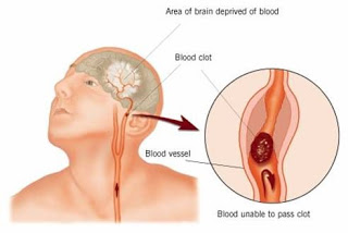 Gejala Penyakit Stroke Dan Obat Alaminya