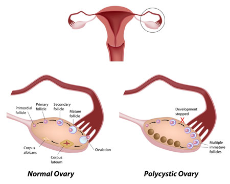 WHAT IS POLYCYSTIC OVARIES? CAUSES, FIRST SIGN OF PCOS?  SYMPTOMS, IS BILATERAL POLYCYSTIC OVARIES DANGEROUS? PCOS PREGNANCY,CAN PCOS GO AWAY? HOW DO YOU GET RID OF PCOS? DIET, DIAGNOSIS,TREATMENT
