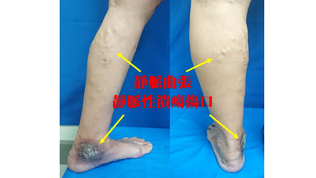 靜脈性潰瘍傷口, 靜脈曲張, 靜脈功能不全, Venous ulcers, varicose veins, venous insufficiency