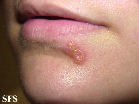 Topical Treatment Of Herpes Simplex : Herpes   Treating The Pain