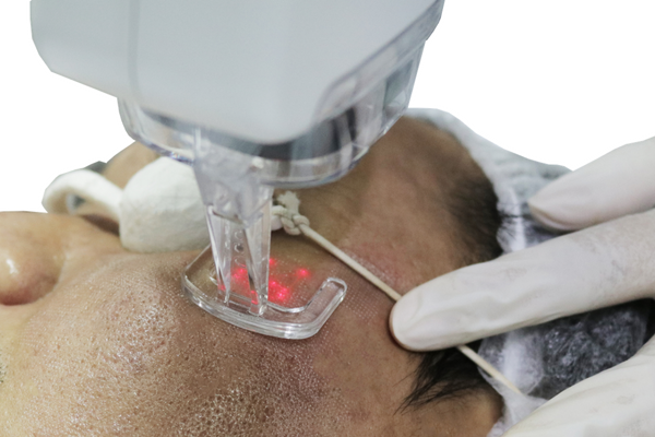 Scar Laser Treatment
