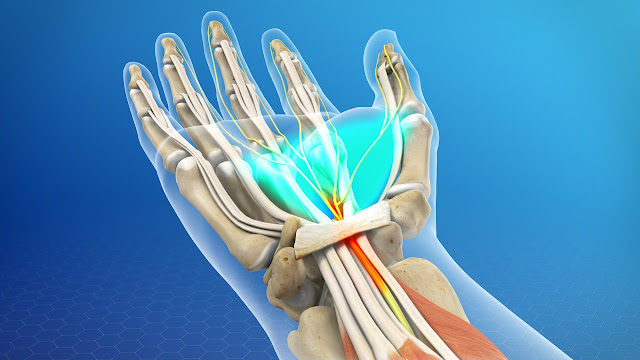  merupakan suatu kondisi terjepitnya saraf median pada pergelangan tangan disebabkan oleh  Faktor Penyebab Carpal Tunnel Syndrome