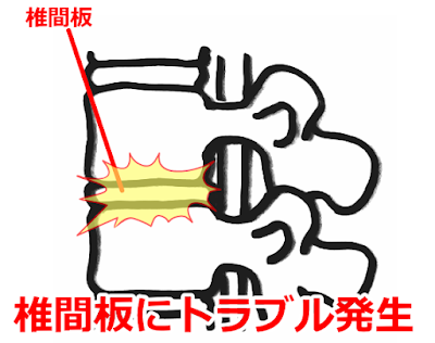 椎間板性の腰痛　神戸やすらぎ訪問マッサージ