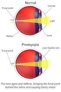 What Is Presbyopia