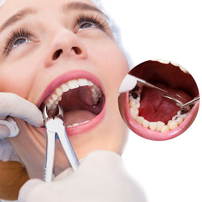 Tác hại niềng răng sai cách bạn cần biết 