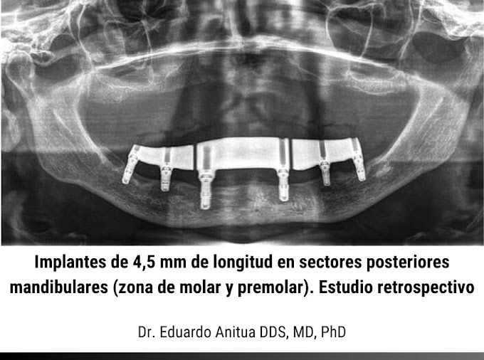 PDF: Implantes de 4,5 mm de longitud en sectores posteriores mandibulares (zona de molar y premolar). Estudio retrospectivo 