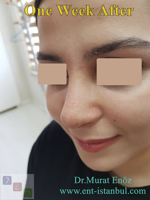 nose aesthetic surgery for female patient, rhinoplasty for women istanbul, nose job in Turkey, one week after rhinoplasty photos